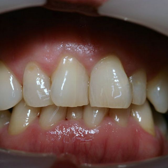 Customer 4 | Teeth Before