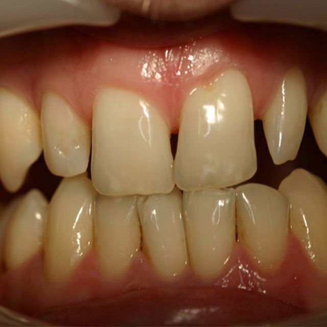 Customer 3 | Teeth Before
